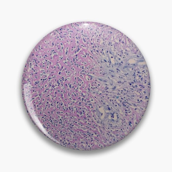 Item preview, Histology of fibrinopurulent exudate, pus, human tissue, H&E, 100x designed and sold by Psymier.