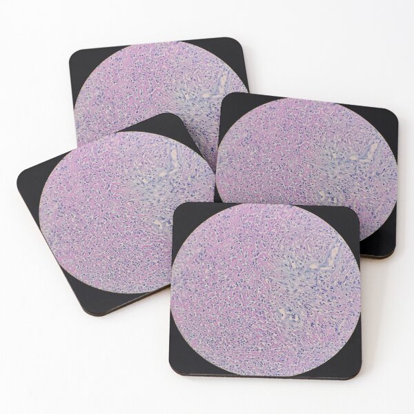 Item preview, Histology of fibrinopurulent exudate, pus, human tissue, H&E, 100x designed and sold by Psymier.
