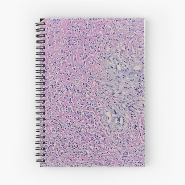 Item preview, Histology of fibrinopurulent exudate, pus, human tissue, H&E, 100x designed and sold by Psymier.