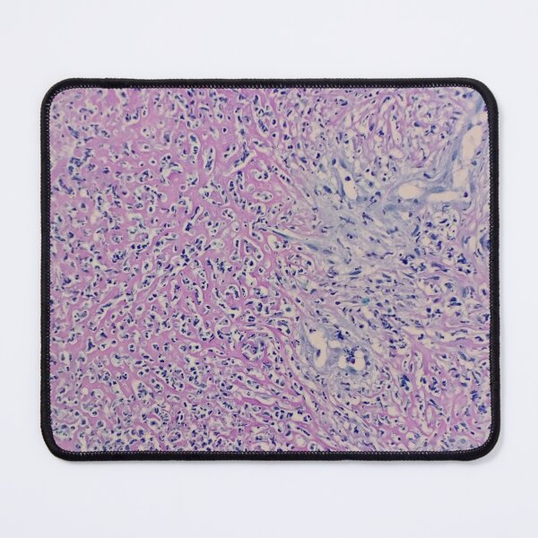 Item preview, Histology of fibrinopurulent exudate, pus, human tissue, H&E, 100x designed and sold by Psymier.