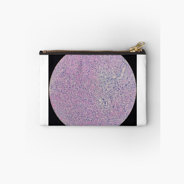 Item preview, Histology of fibrinopurulent exudate, pus, human tissue, H&E, 100x designed and sold by Psymier.