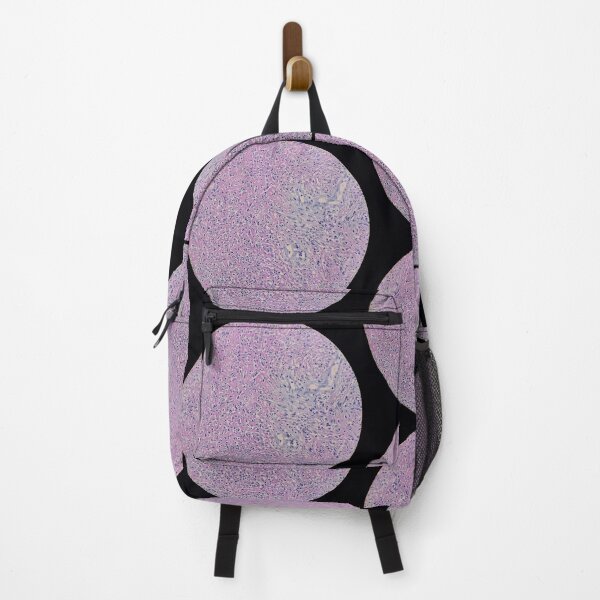 Item preview, Histology of fibrinopurulent exudate, pus, human tissue, H&E, 100x designed and sold by Psymier.