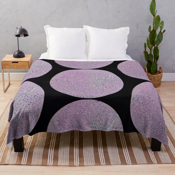 Item preview, Histology of fibrinopurulent exudate, pus, human tissue, H&E, 100x designed and sold by Psymier.