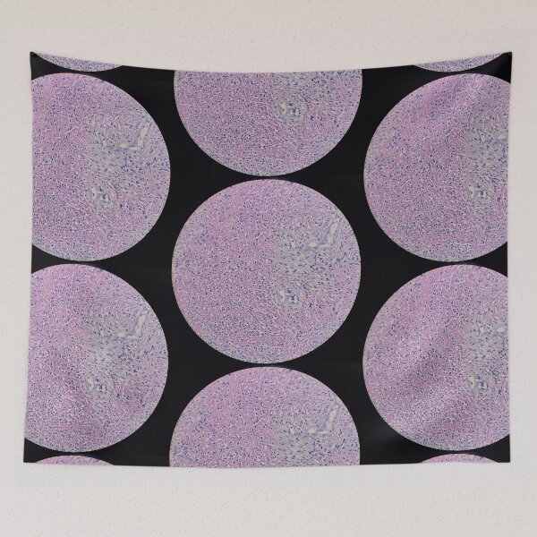 Item preview, Histology of fibrinopurulent exudate, pus, human tissue, H&E, 100x designed and sold by Psymier.