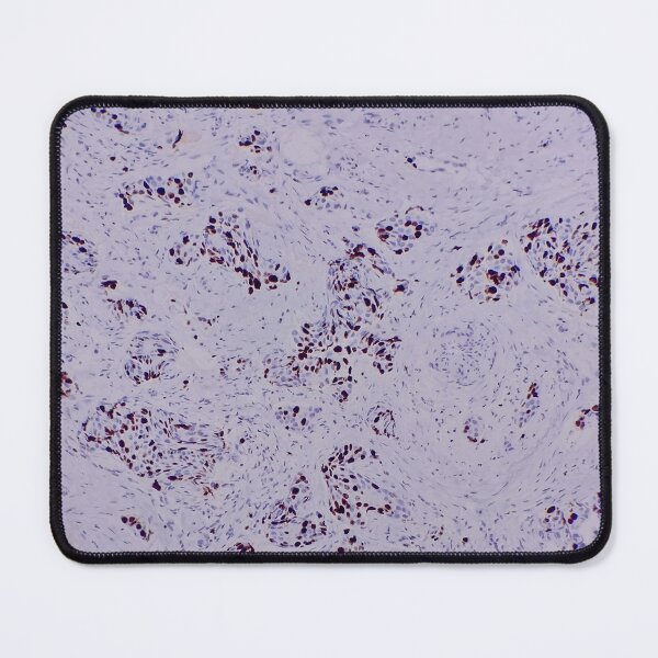 Item preview, Histology of breast cancer, human tissue, Ki67 immunohistochemistry, 40x designed and sold by Psymier.