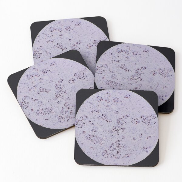 Item preview, Histology of breast cancer, human tissue, Ki67 immunohistochemistry, 40x designed and sold by Psymier.