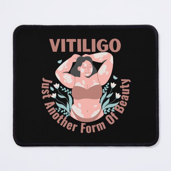 Item preview, Vitiligo Just Another Form Of Beauty Female Model designed and sold by MimsTees.
