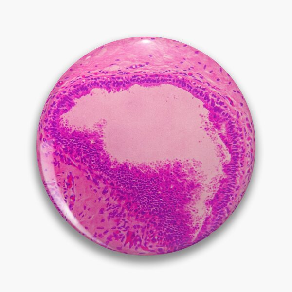 Item preview, Cancer Invasion (Breast Cancer) designed and sold by CellPathWorld.