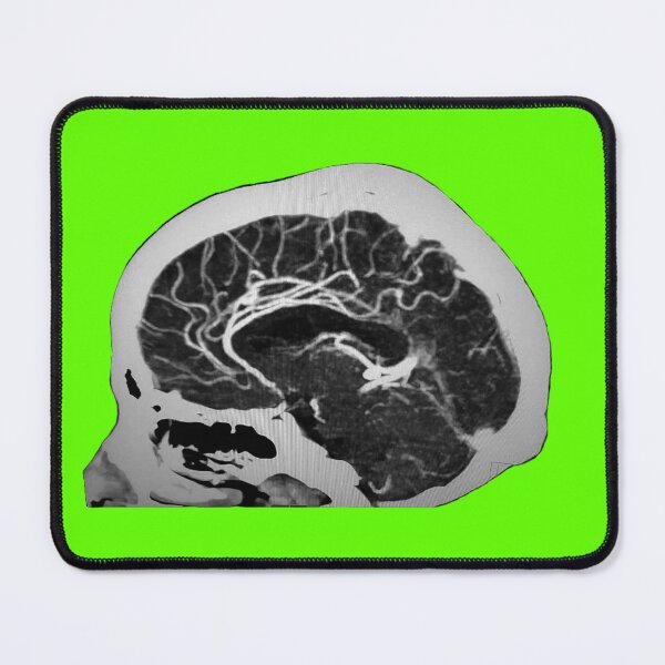 Item preview, Sagittal Cerebral Angiography Image designed and sold by Creative Endeavors ..
