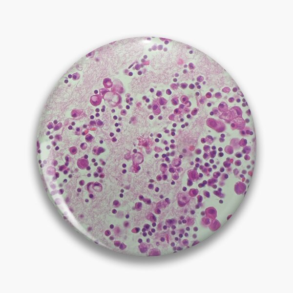 Item preview, Cell block of a pleural fluid designed and sold by CellPathWorld.