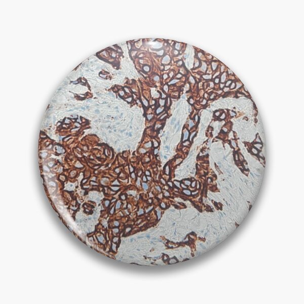 Item preview, E-Cadherin positive case in breast (IHC)  designed and sold by CellPathWorld.