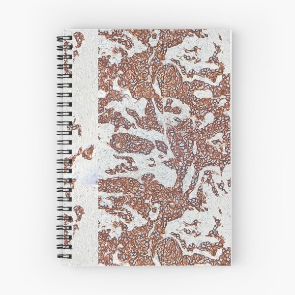 Item preview, E-Cadherin positive case in breast (IHC)  designed and sold by CellPathWorld.