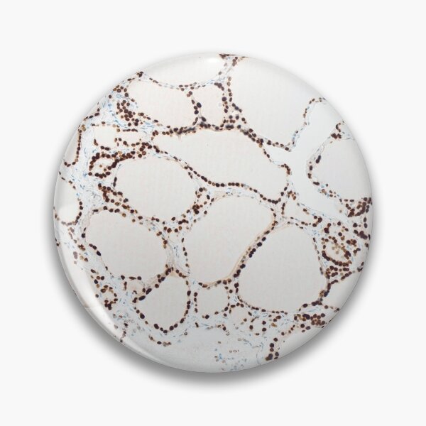 Item preview, TTF1 IHC marker in thyroid designed and sold by CellPathWorld.