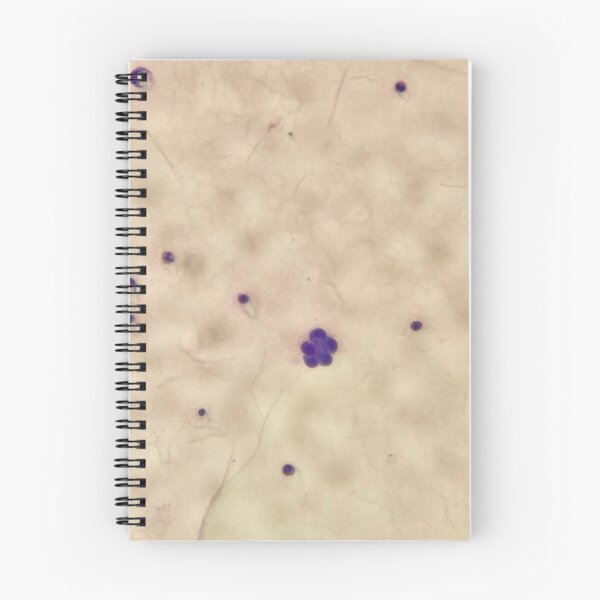 Item preview, Giemsa stain flowers (pleural fluid) designed and sold by CellPathWorld.