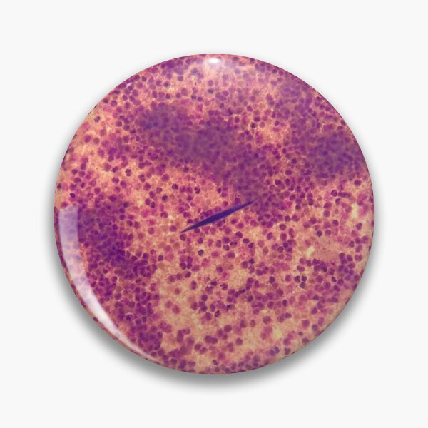 Item preview, Charcot-Leyden crystals in pleural fluid designed and sold by CellPathWorld.