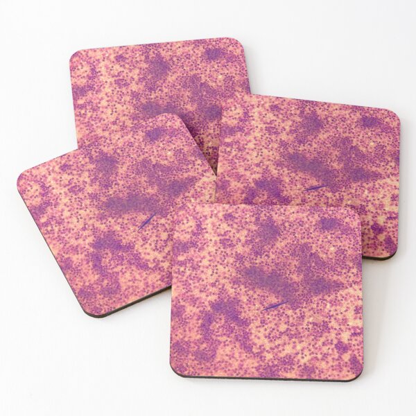 Item preview, Charcot-Leyden crystals in pleural fluid designed and sold by CellPathWorld.