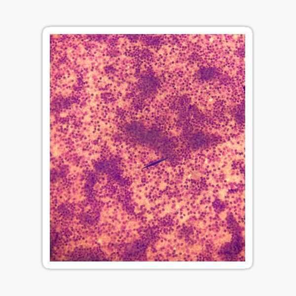 Item preview, Charcot-Leyden crystals in pleural fluid designed and sold by CellPathWorld.