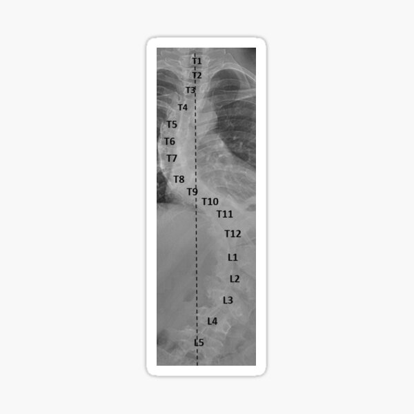 Item preview, Scoliosis designed and sold by Black-Beck.
