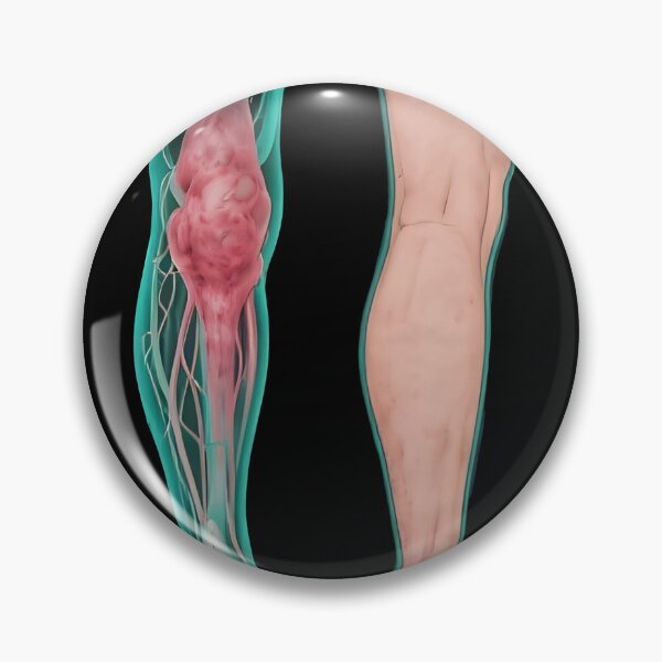 Item preview, Lymphedema designed and sold by Uglyandcute.