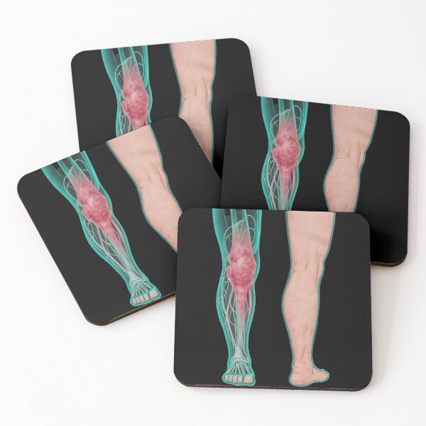 Item preview, Lymphedema designed and sold by Uglyandcute.