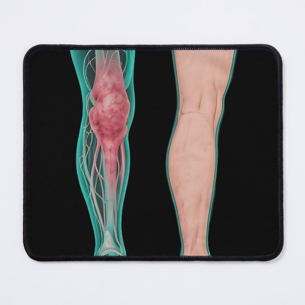 Item preview, Lymphedema designed and sold by Uglyandcute.