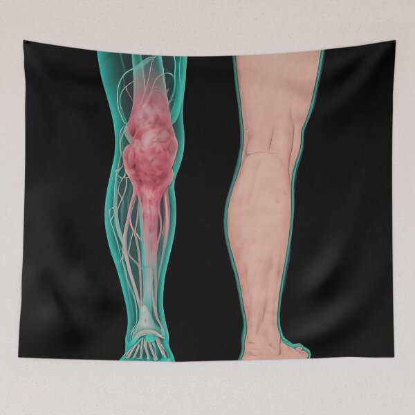 Item preview, Lymphedema designed and sold by Uglyandcute.