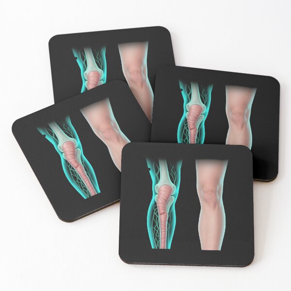 Item preview, Lymphedema designed and sold by Uglyandcute.