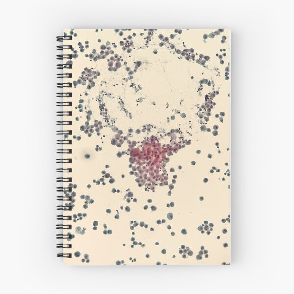Item preview, Bronchoalveolar lavage cytology designed and sold by CellPathWorld.