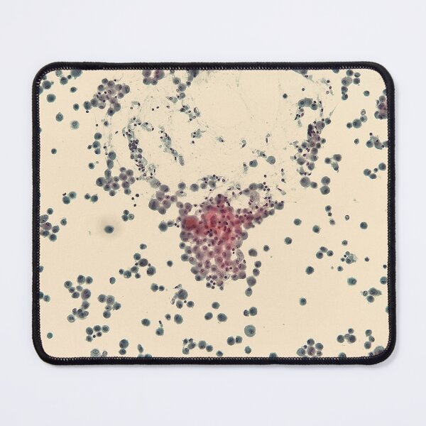 Item preview, Bronchoalveolar lavage cytology designed and sold by CellPathWorld.
