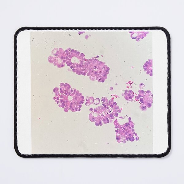Item preview, Adenocarcinoma cells found in a cell block designed and sold by CellPathWorld.