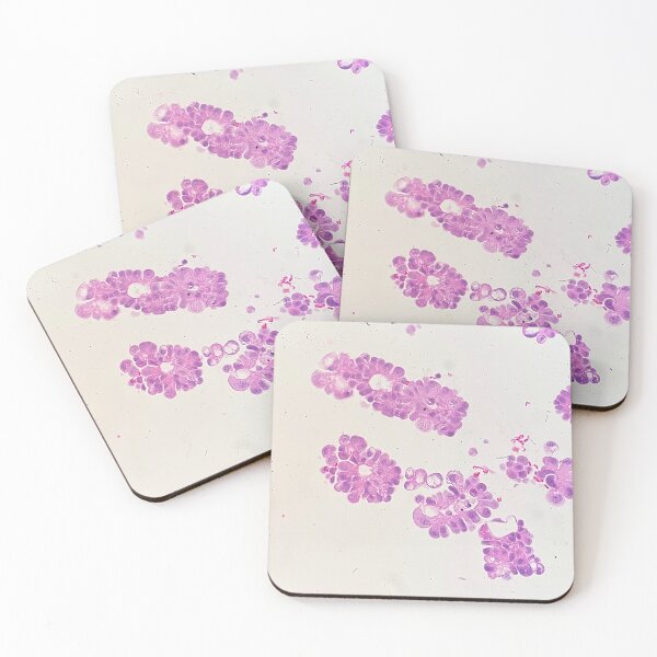 Item preview, Adenocarcinoma cells found in a cell block  designed and sold by CellPathWorld.