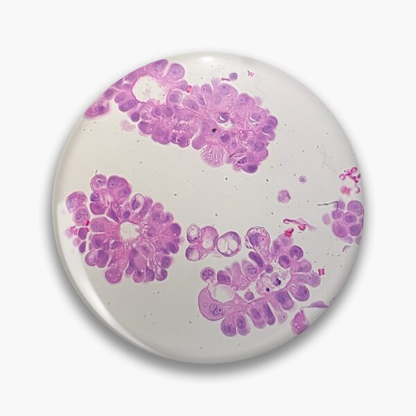 Item preview, Adenocarcinoma cells found in a cell block  designed and sold by CellPathWorld.