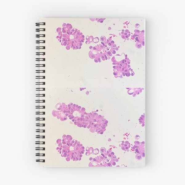 Item preview, Adenocarcinoma cells found in a cell block designed and sold by CellPathWorld.
