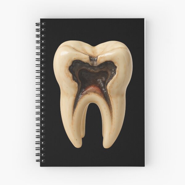 Item preview, Severely Decayed Tooth with Deep Cavity Reaching the Nerve – Root Canal Stage designed and sold by RokaCircles.