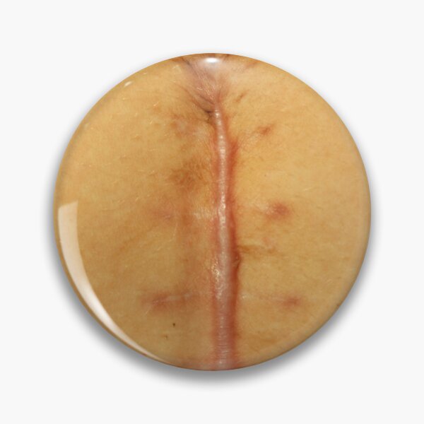 Item preview, big seams after operation of Caesarian section. Close-up of a vertical midline abdominal surgical scar after operation. Macro shot of healing surgical incision with visible suture marks  designed and sold by Decoriolus.