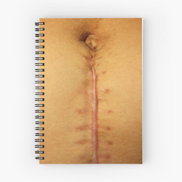 Item preview, big seams after operation of Caesarian section. Close-up of a vertical midline abdominal surgical scar after operation. Macro shot of healing surgical incision with visible suture marks  designed and sold by Decoriolus.