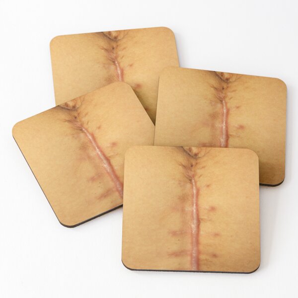 Item preview, big seams after operation of Caesarian section. Close-up of a vertical midline abdominal surgical scar after operation. Macro shot of healing surgical incision with visible suture marks  designed and sold by Decoriolus.