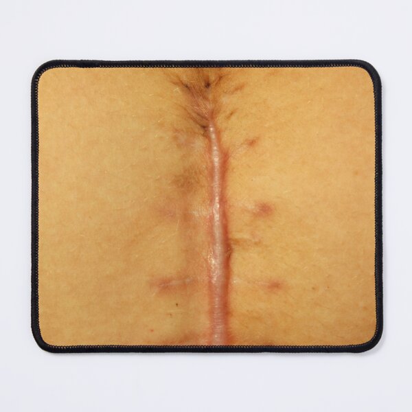 Item preview, big seams after operation of Caesarian section. Close-up of a vertical midline abdominal surgical scar after operation. Macro shot of healing surgical incision with visible suture marks designed and sold by Decoriolus.