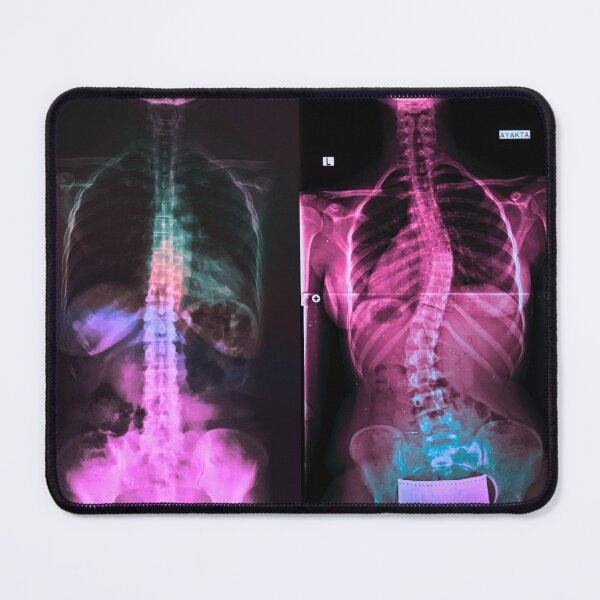 Item preview, Baddie Inside Out – Scoliosis X-Ray Y2K Graphic designed and sold by mooncakekaro.