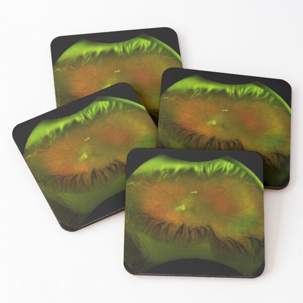 Item preview, Optos Image of Left Retina with Lattice Degeneration designed and sold by trabeculae carneae.
