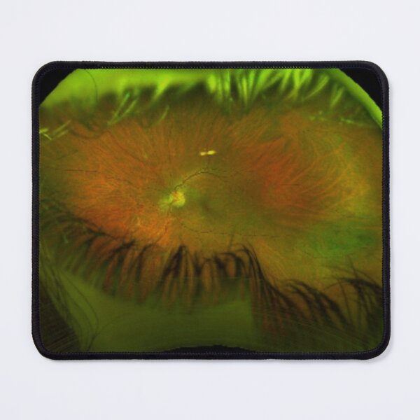 Item preview, Optos Image of Left Retina with Lattice Degeneration designed and sold by trabeculae carneae.