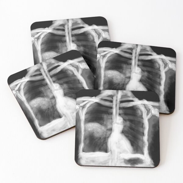 Item preview, Community Acquired Pneumonia designed and sold by ascherf.