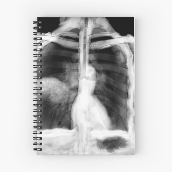Item preview, Community Acquired Pneumonia designed and sold by ascherf.