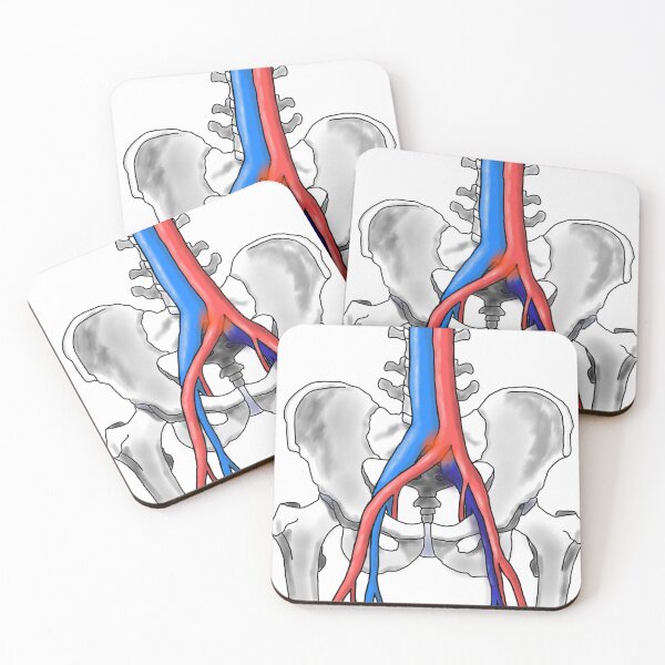 Item preview, May-Thurner Syndrome designed and sold by ascherf.