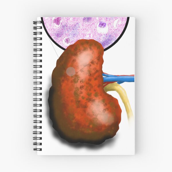 Item preview, End Stage Renal Disease designed and sold by ascherf.