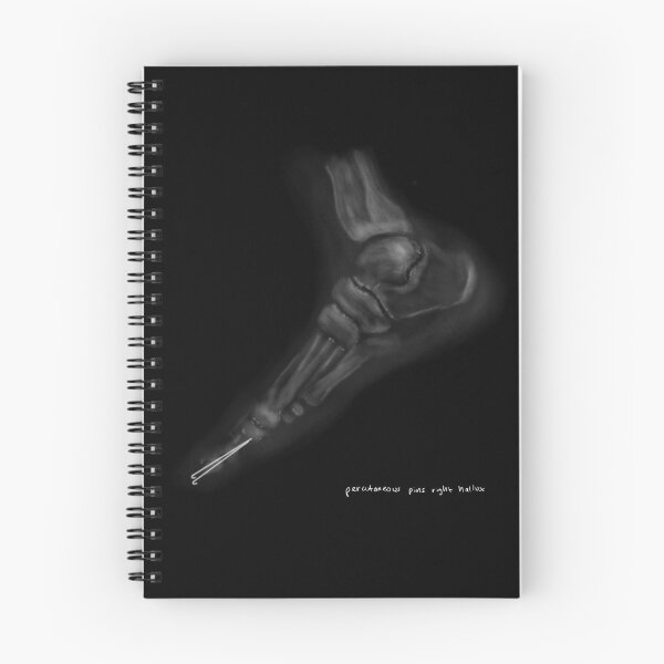 Item preview, Right Hallux Fixation designed and sold by ascherf.