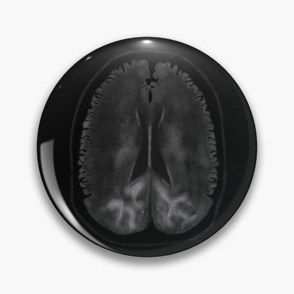 Item preview, Posterior Reversible Encephalopathy Syndrome designed and sold by ascherf.