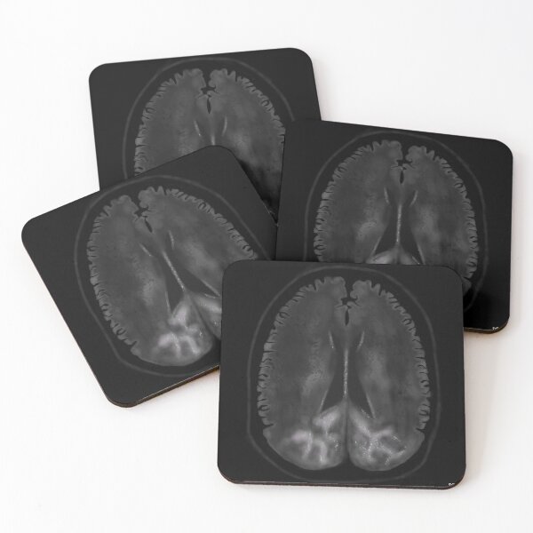 Item preview, Posterior Reversible Encephalopathy Syndrome designed and sold by ascherf.