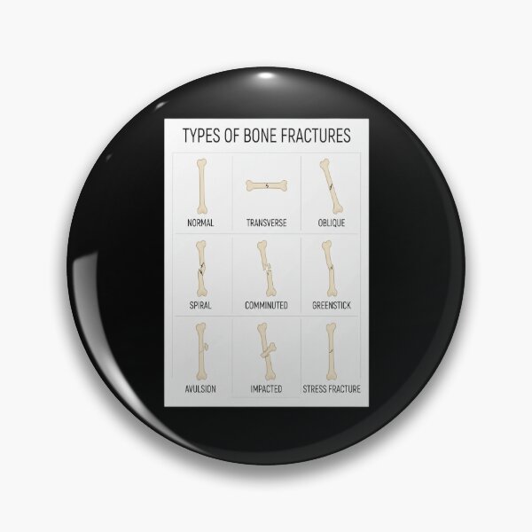 Item preview, Hand Drawn Types of Fractures designed and sold by Shopun.