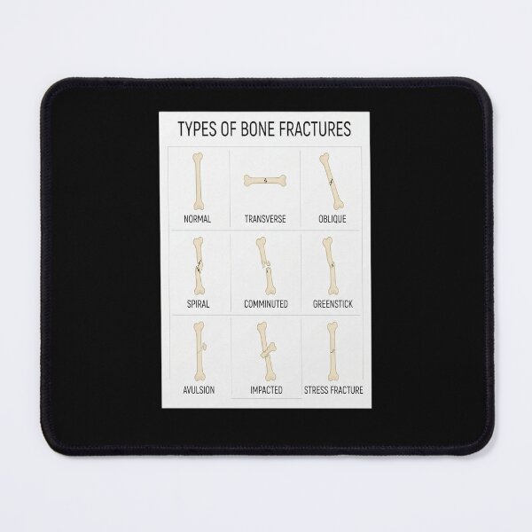Item preview, Hand Drawn Types of Fractures designed and sold by Shopun.